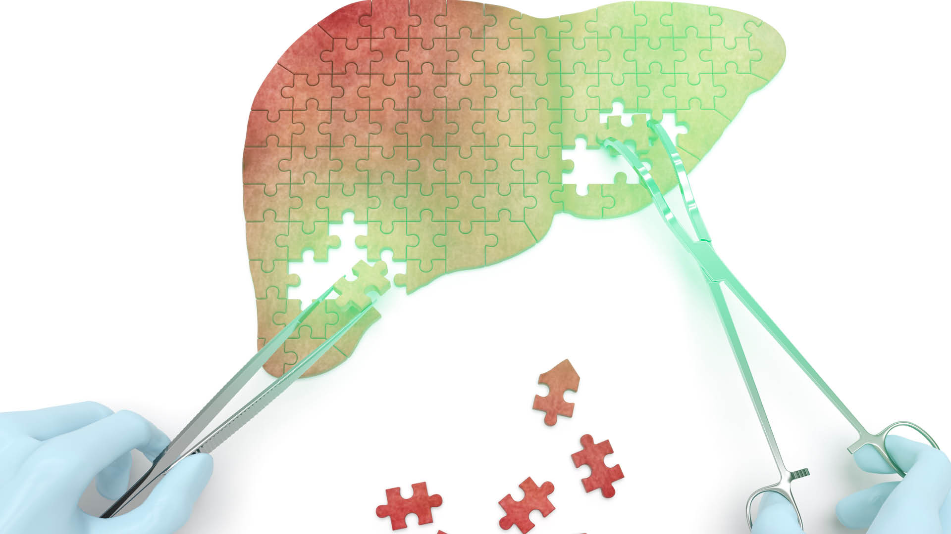Illustration einer Leber aus Puzzleteilen, die von zwei ärztlichen Händen mit Instrumenten zusammengesetzt wird – symbolische Darstellung von Diagnose und Therapie bei Fettleber und MASH.