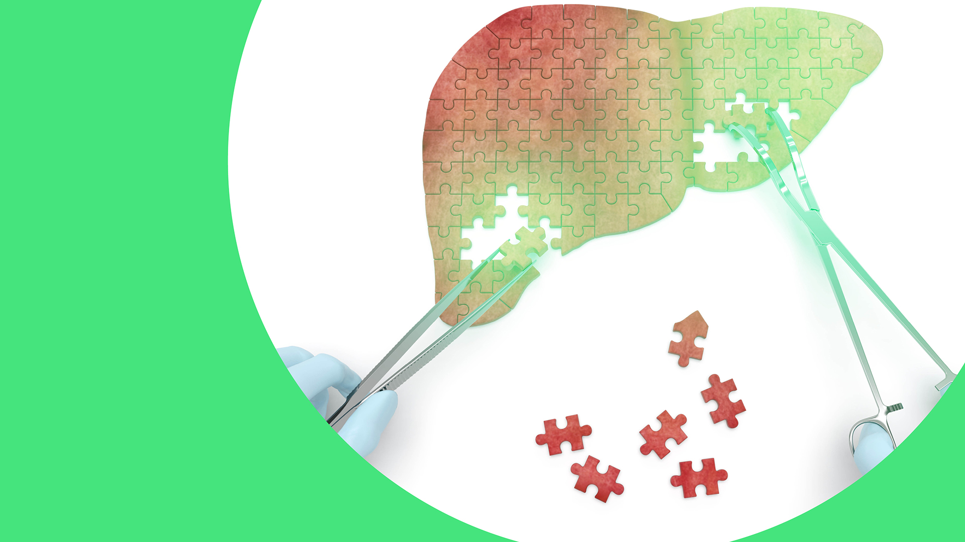 Illustration einer Leber aus Puzzleteilen, die von zwei ärztlichen Händen mit Instrumenten zusammengesetzt wird – symbolische Darstellung von Diagnose und Therapie bei Fettleber und MASH.
